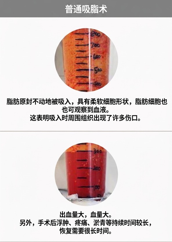 普通吸脂 — 含血脂肪、组织损伤多、恢复时间长