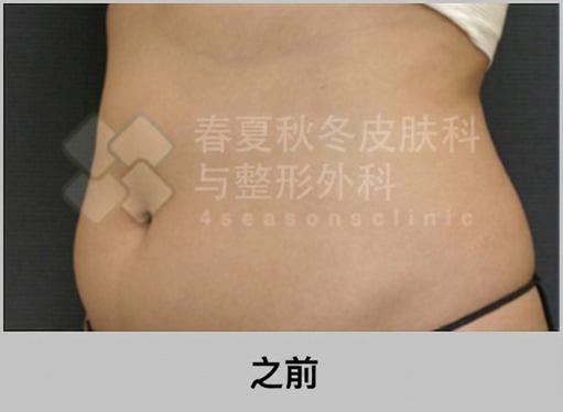 威塑吸脂效果 — 术前