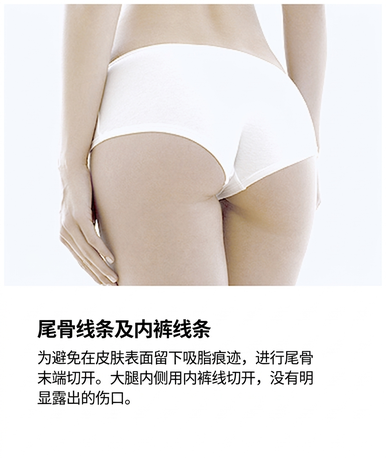 威塑吸脂切口 — 尾骨与内裤线,无明显疤痕