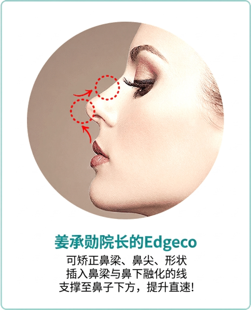 姜院长Edge Nose — 用可吸收线垫高并矫正鼻梁与鼻尖