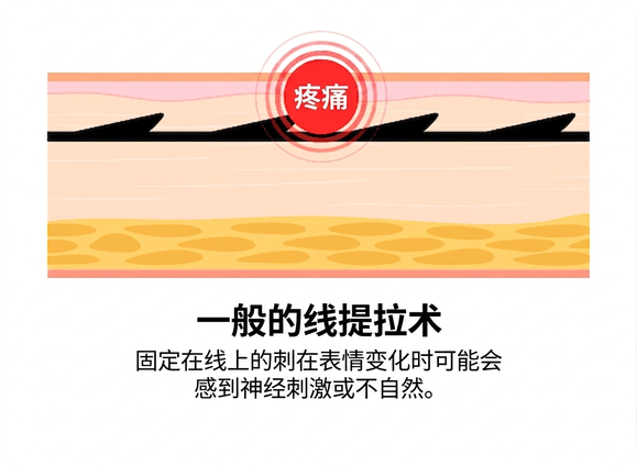普通线雕 — 固定倒刺可致神经刺激与疼痛